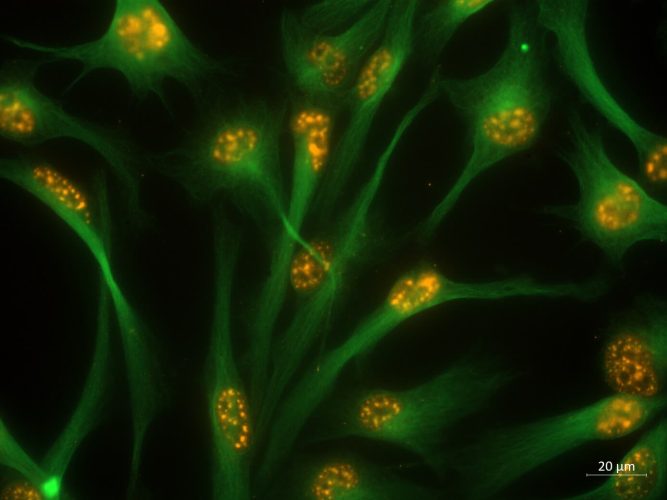 Microscopía de fluorescencia de un cultivo de células madre de glioblastoma