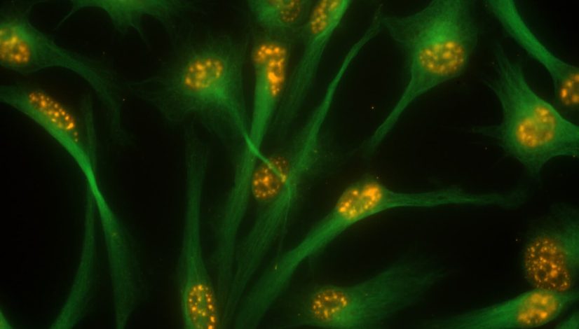 Microscopía de fluorescencia de un cultivo de células madre de glioblastoma