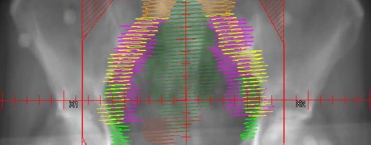 Radiation_Endometrial. Tdvorak, CC BY-SA 3.0 <https://creativecommons.org/licenses/by-sa/3.0>, via Wikimedia Commons